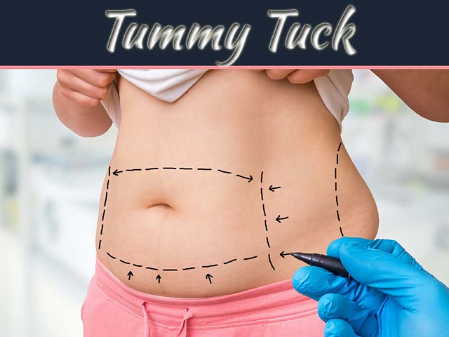 How A Tummy Tuck Can Benefit Your Overall Health