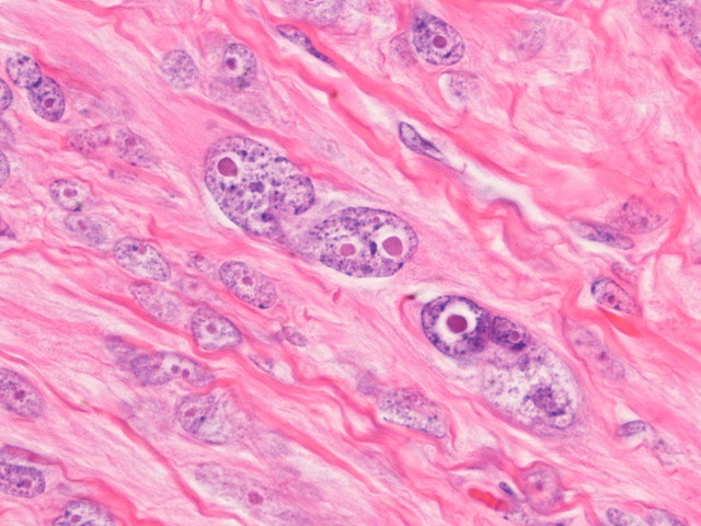 Hereditary Leiomyomatosis/Renal Cell Carcinoma (HLRCC)