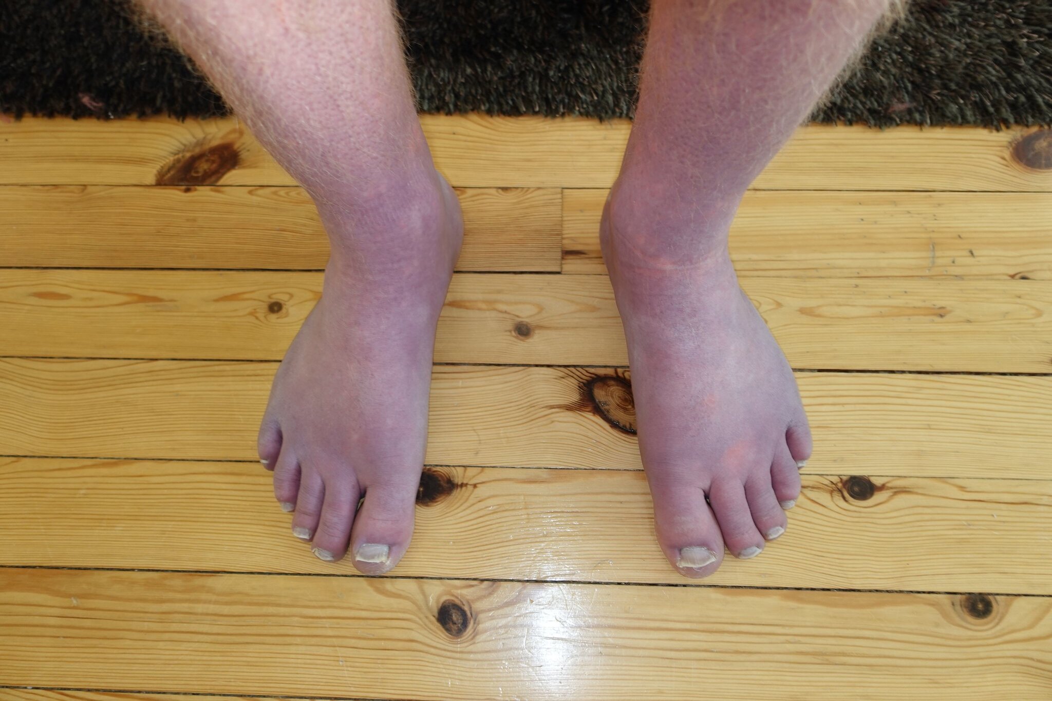 Dependent Acrocyanosis in a Norwegian 33-year old male POTS patient
