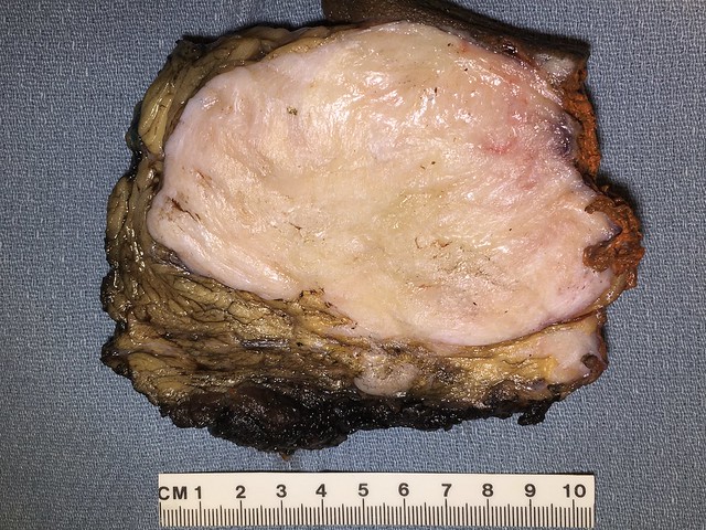 Qiao's Pathology: Desmoid Type Fibromatosis of the Breast
