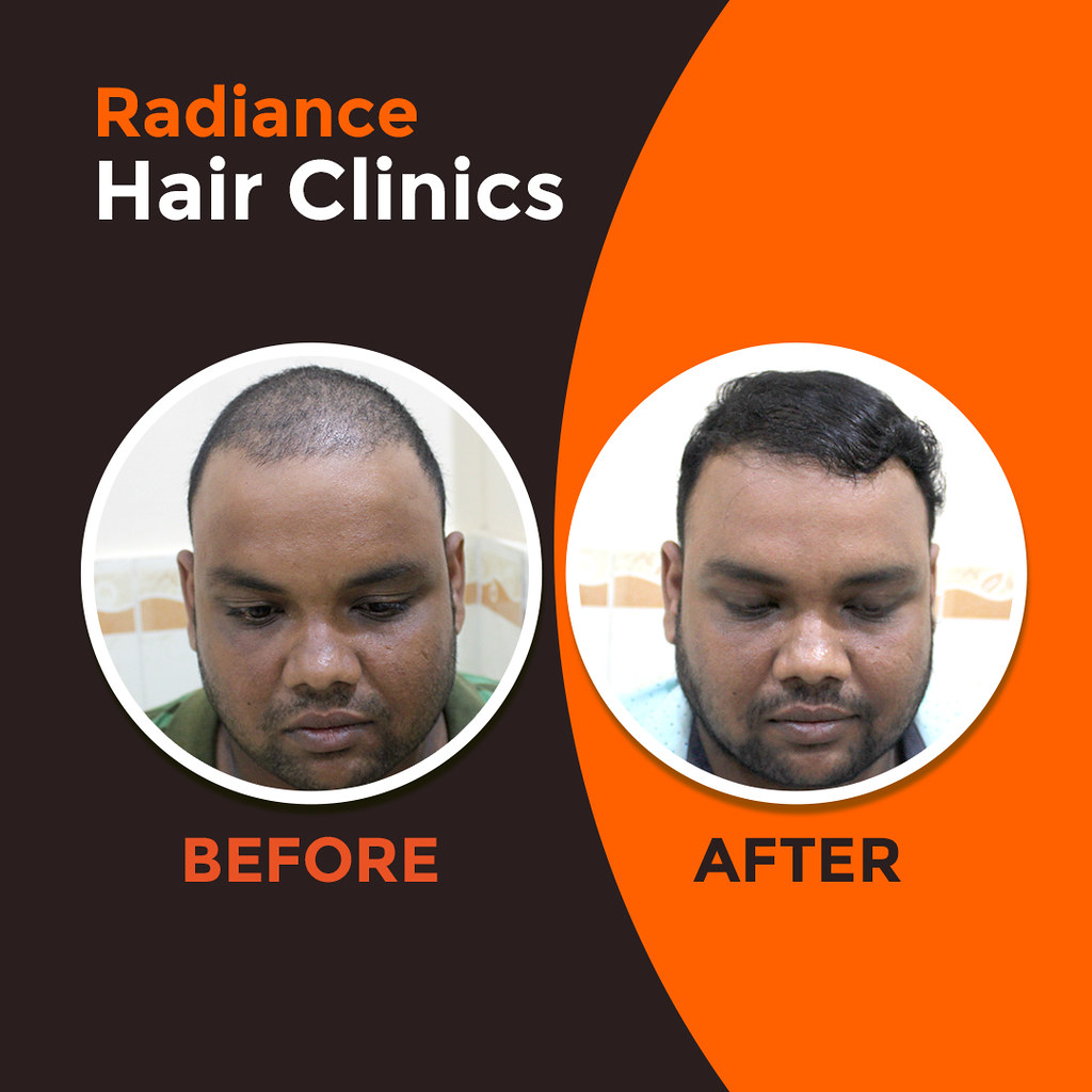 Hair Transplant In Bhubaneswar | Are you in search of a well… | Flickr