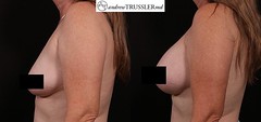 breast augmentation surgery austin, breast augmentation, breast plastic surgery austin, breast augmentation austin, breast augmentation austin tx