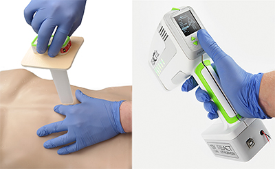  The REACT system uses a rapid, inflatable Tamponade device that is inserted into the stab wound. The automated inflation of this Tamponade provides internal pressure direct to the bleeding site, controlling bleeding faster than current methods.