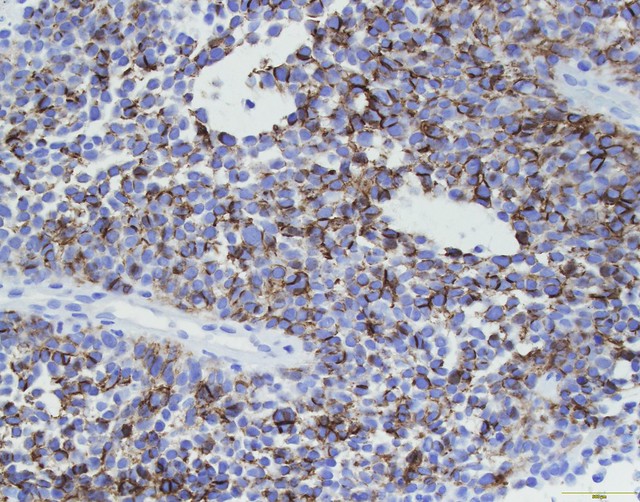 Qiao's Pathology: Primary Small Cell Carcinoma of the Breast