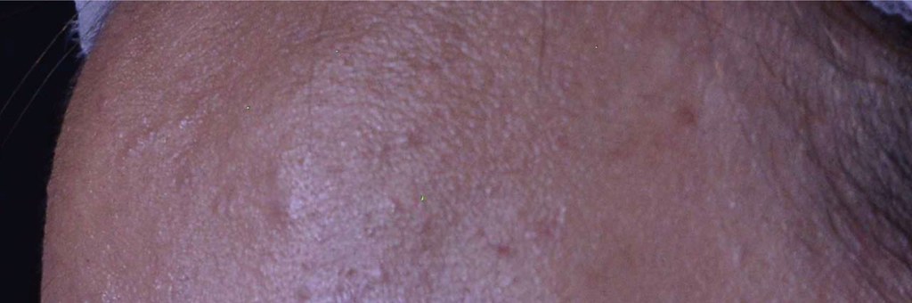 達昇皮膚科幫你治療蠕形蟎蟲！專業的皮膚科診所推薦達昇皮膚科！