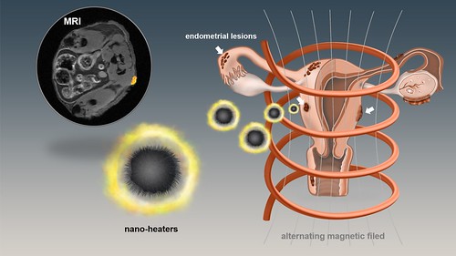 magnetic nanoparticle hyperthermia