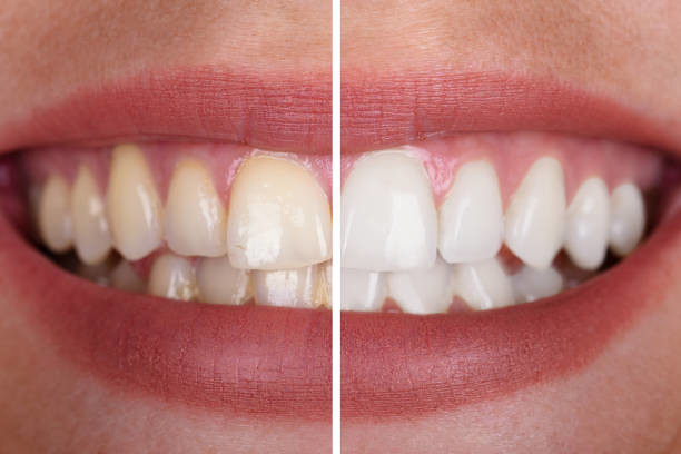 Treatment For Teeth Whitening In Kelowna