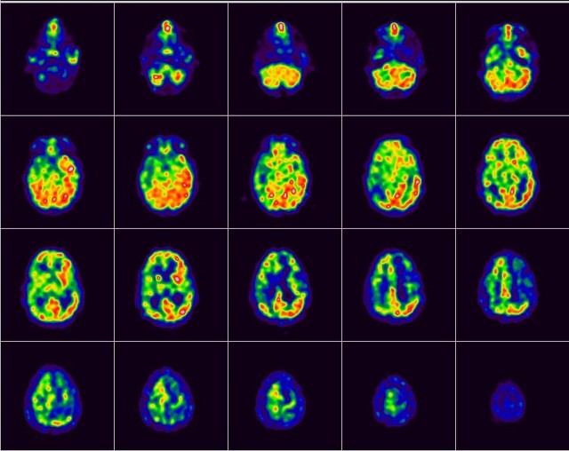 fig.2 Immagini di sezioni del cervello sotto stimolazione sensoriale (Neuroimaging)