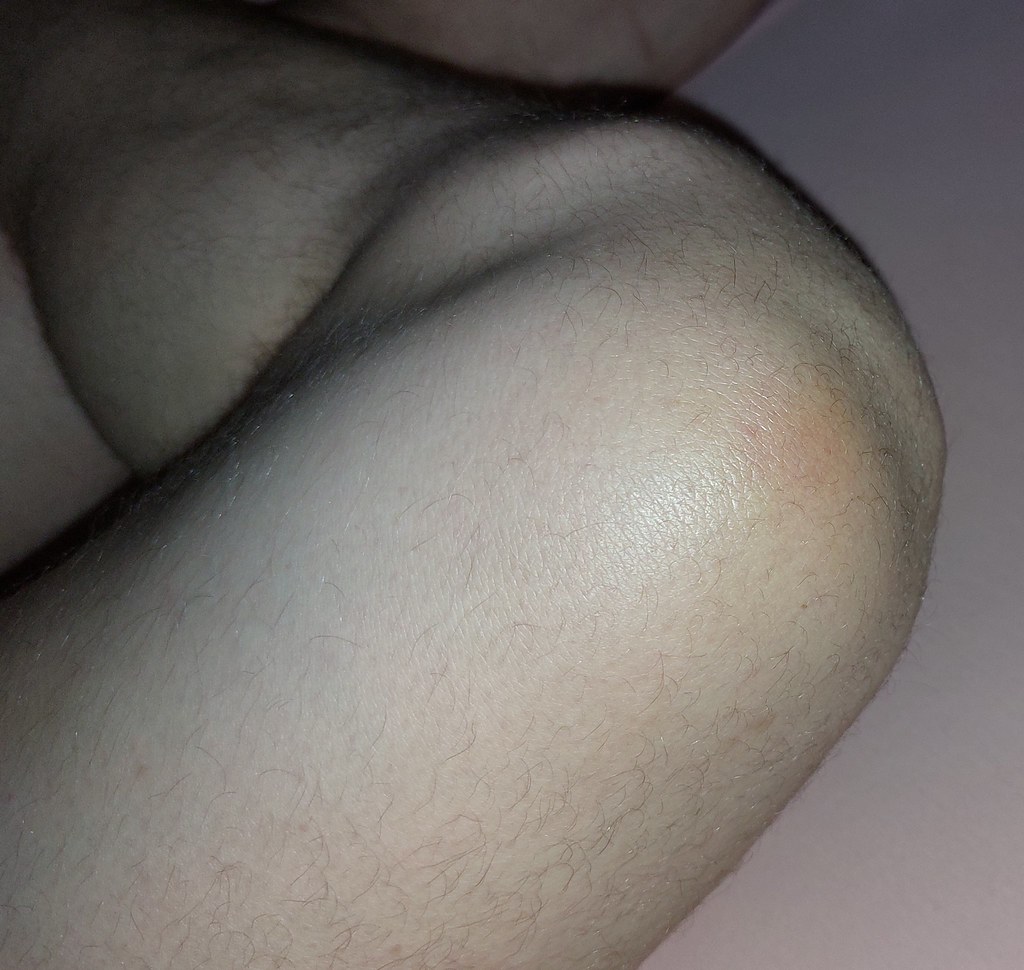 Knee swelling
