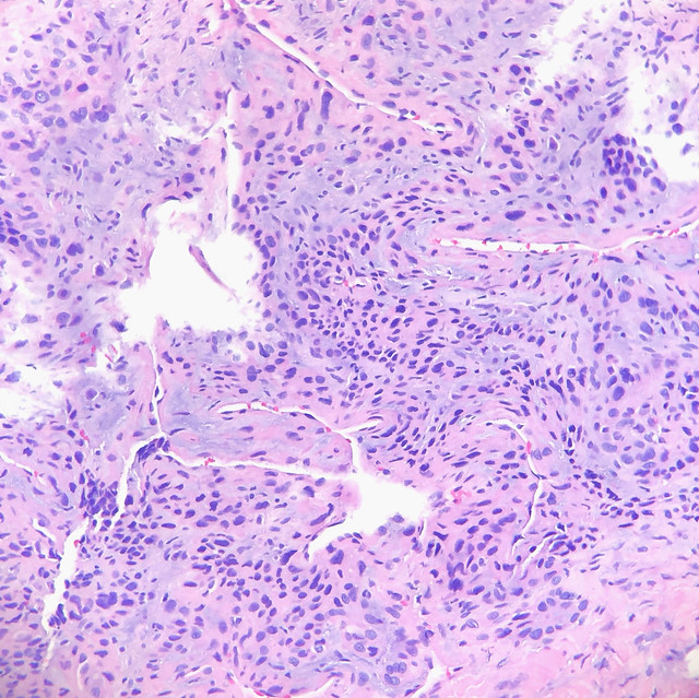 Symplastic Glomus Tumor