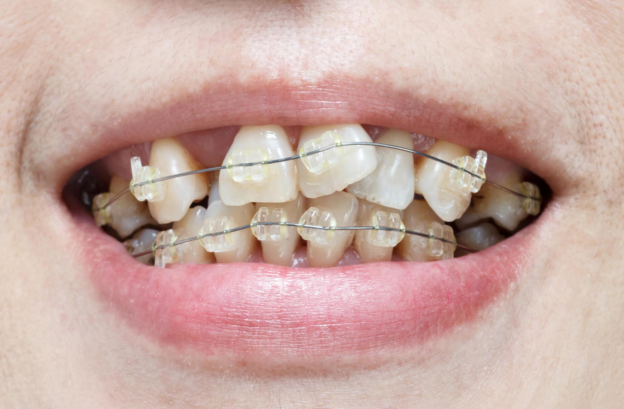niềng răng 1 hàm cho răng khấp khểnh