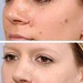 Cosmetic Mole Removal Home Remedy