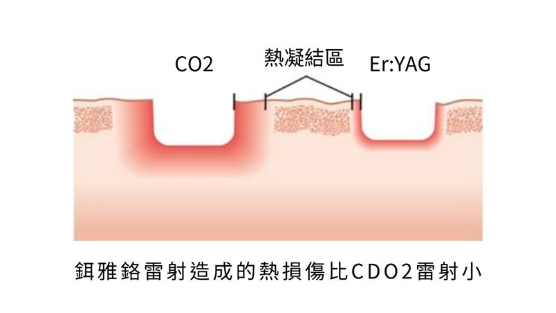 鉺雅鉻雷射是磨皮雷射的一種，鉺雅鉻雷射對於治療凹痘疤特別的有效！如果你對雷射的修復期感到害怕或者你沒辦法接受長時間的恢復期，你可以嘗試另一種可以看的到效果的的凹痘疤雷射治療-西頓鉺雅鉻雷射！