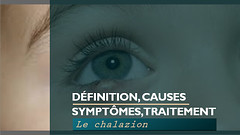 Le chalazion  que faire face  causes, symptômes et traitement.