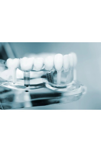 Is A Patient Sedated When Getting A Dental Implant | by mauroalezno