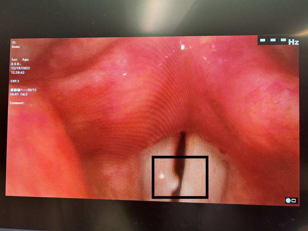 From my second videostroboscopy, here it is evident that the spot on my vocal cord has just gotten bigger
