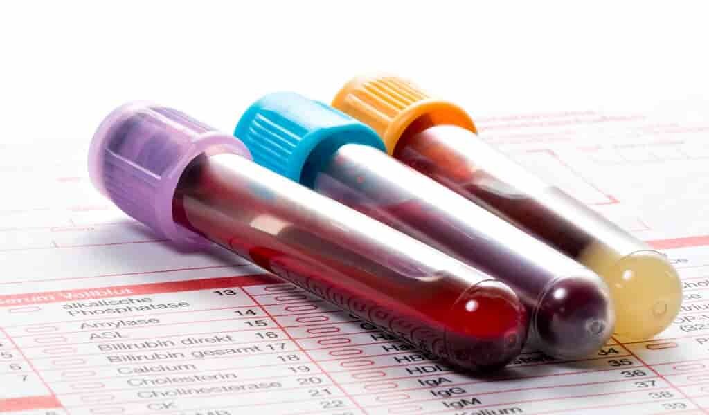 un-test-sanguin-pour-percer-les-mystères-du-cancer-de-la-prostate