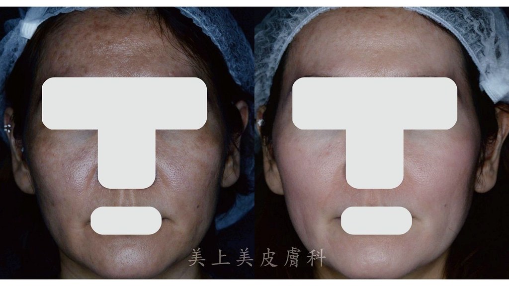 三階段煥膚是更深層的酸類換膚，對於青春痘治療、粉刺治療、皮膚老化、皮膚暗沉、毛孔縮小有更好的治療效果
