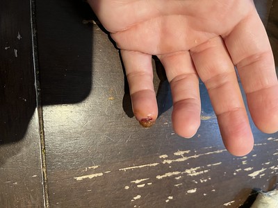 Finger amputation recovery - day 12