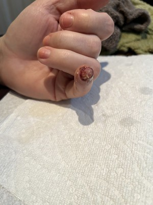 Finger amputation recovery - day 7