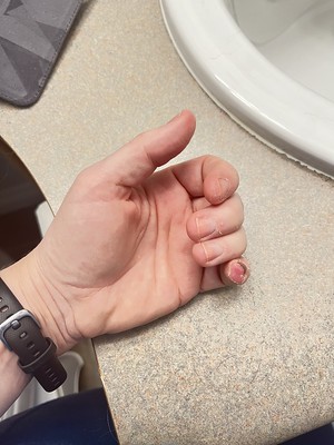 Finger amputation - day 27