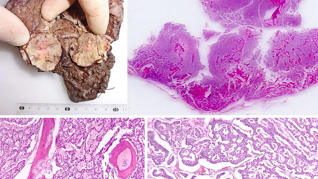 Intrabrnchial ossified typical carcinoid