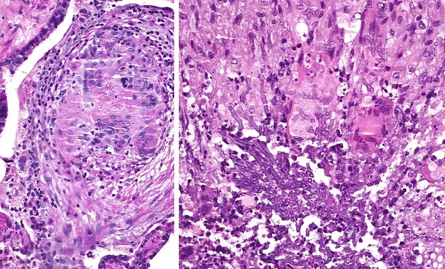 Aspergillus infection, granulomatous