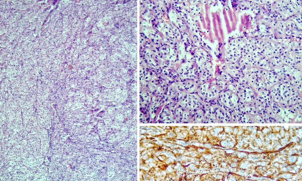 Glomus tumor of lung