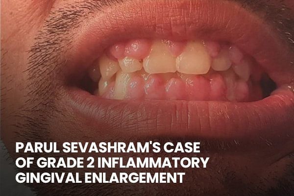 Parul Sevashram's Case Of Grade 2 Inflammatory Gingival Enlargement