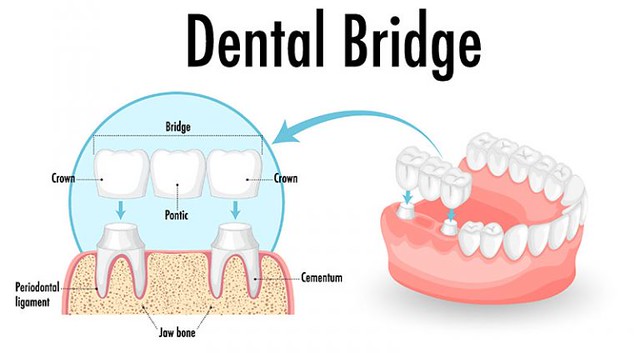 Evolution of Dental Bridges