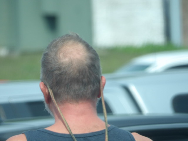 Nape of Man with Bald Spot