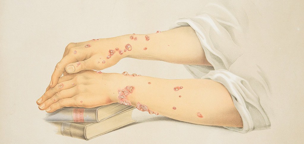 Hands and Forearms Showing Herpes Iris