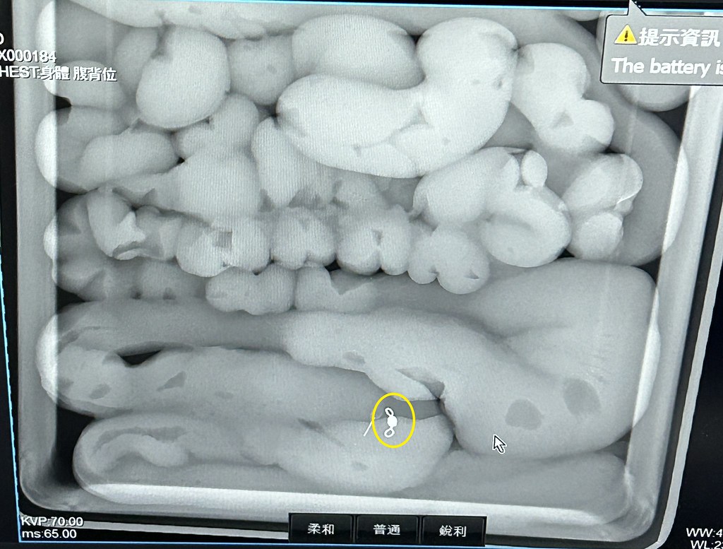 X光拍攝腸道有金屬物（圖中黃色圈），經確認為魚線轉接環。圖片來源：海保署提供