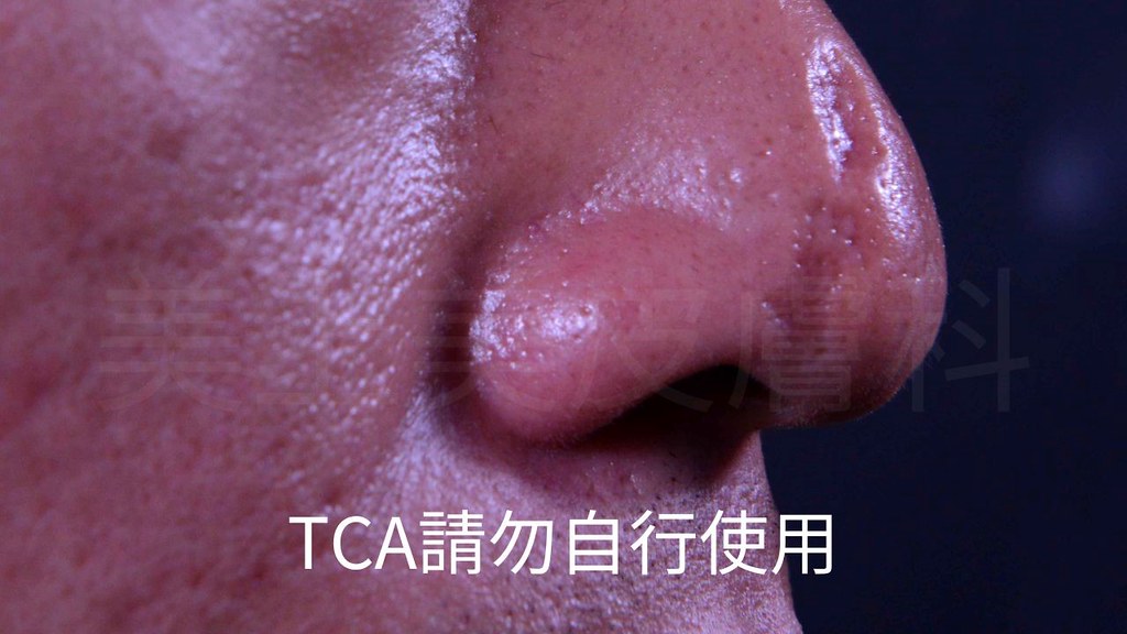 TCA深層換膚是痘疤治療中很厲害的一種治療，這種痘疤治療專治冰鑿型痘疤跟廂型痘疤，TCA深層換膚這種痘疤治療方式，對於冰鑿型痘疤跟廂型痘疤的患者，是很有效的一種治療