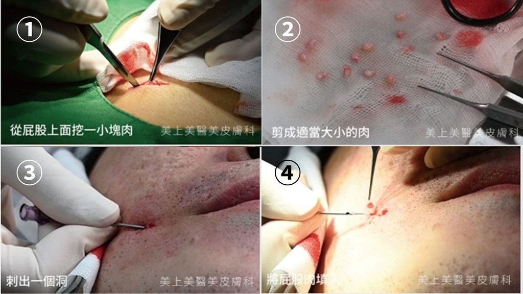 凹痘疤治療-穿刺移植與真皮移植