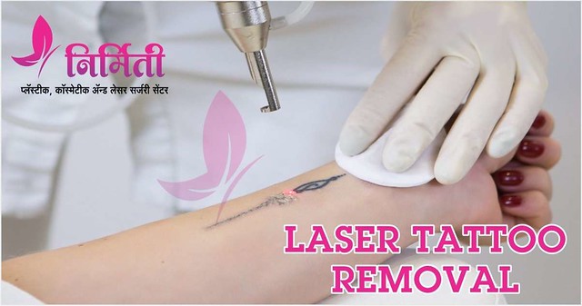 Laser Tattoo Removal in Sangli
