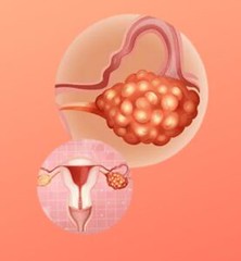 Ovarian Cyst Treatment - Top Gynaecologists UK - 1