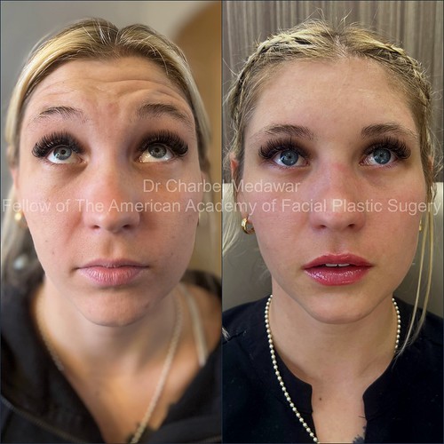 lip fillers botox beirut lebanon plastic surgery style beauty clinic dr charbel medawar 2 | by drcharbelmedawar
