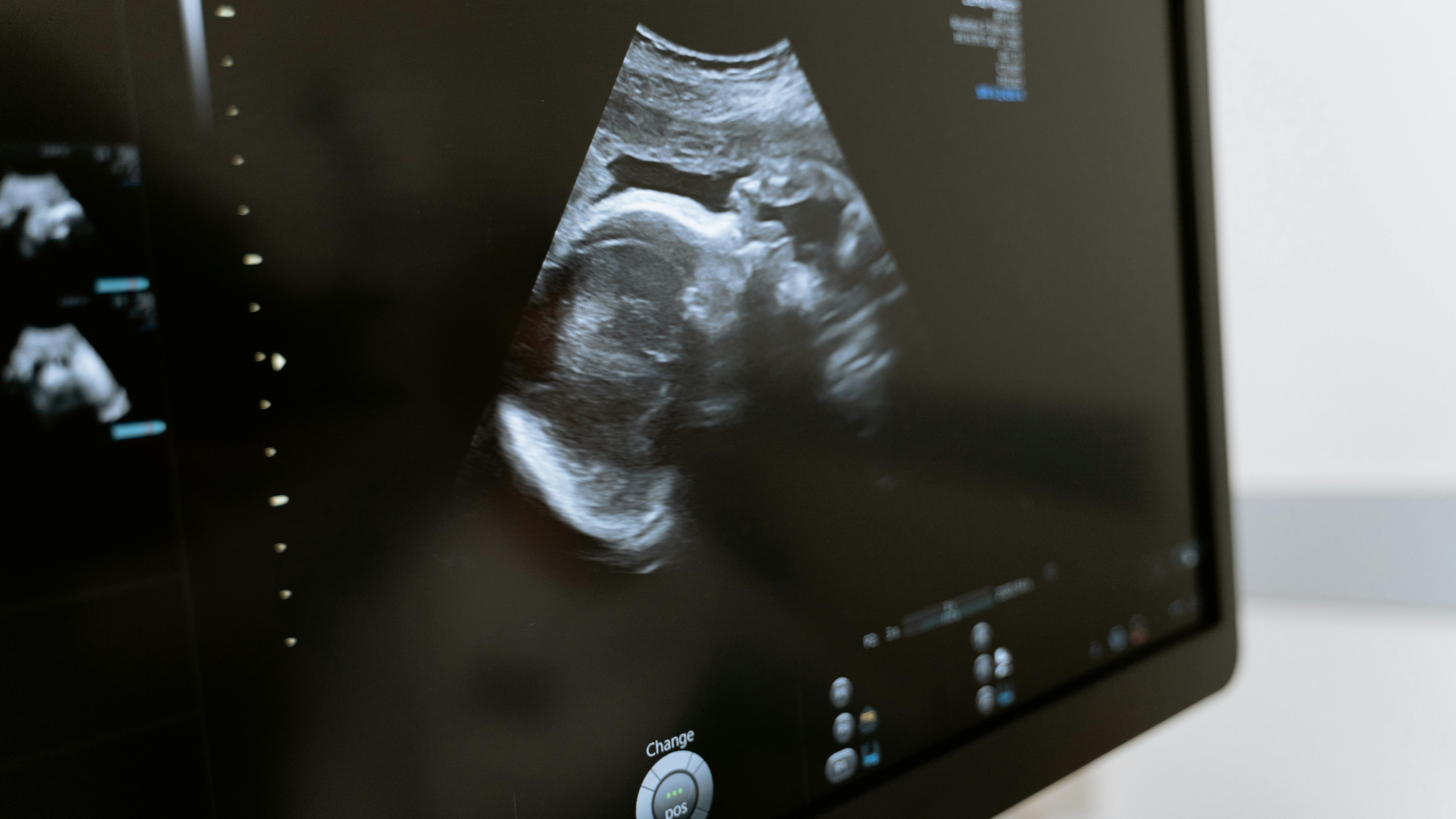 Screen showing an ultrasound of a baby
