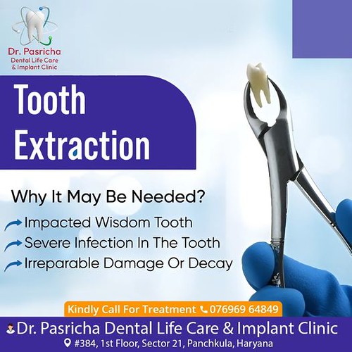 Understanding Tooth Extraction: Why It May Be Needed. Explore the reasons behind this common dental procedure for optimal oral health.
