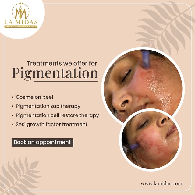 Treatments offered by La Midas Aesthetics for Pigmentation Treatment