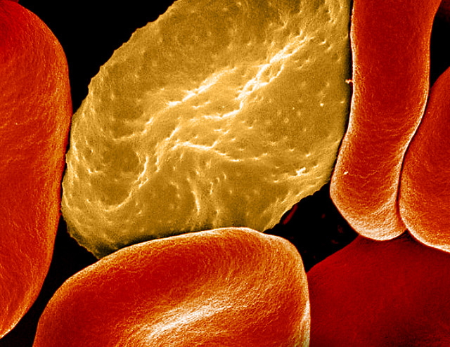 Red Blood Cell Infected with Malaria Parasites