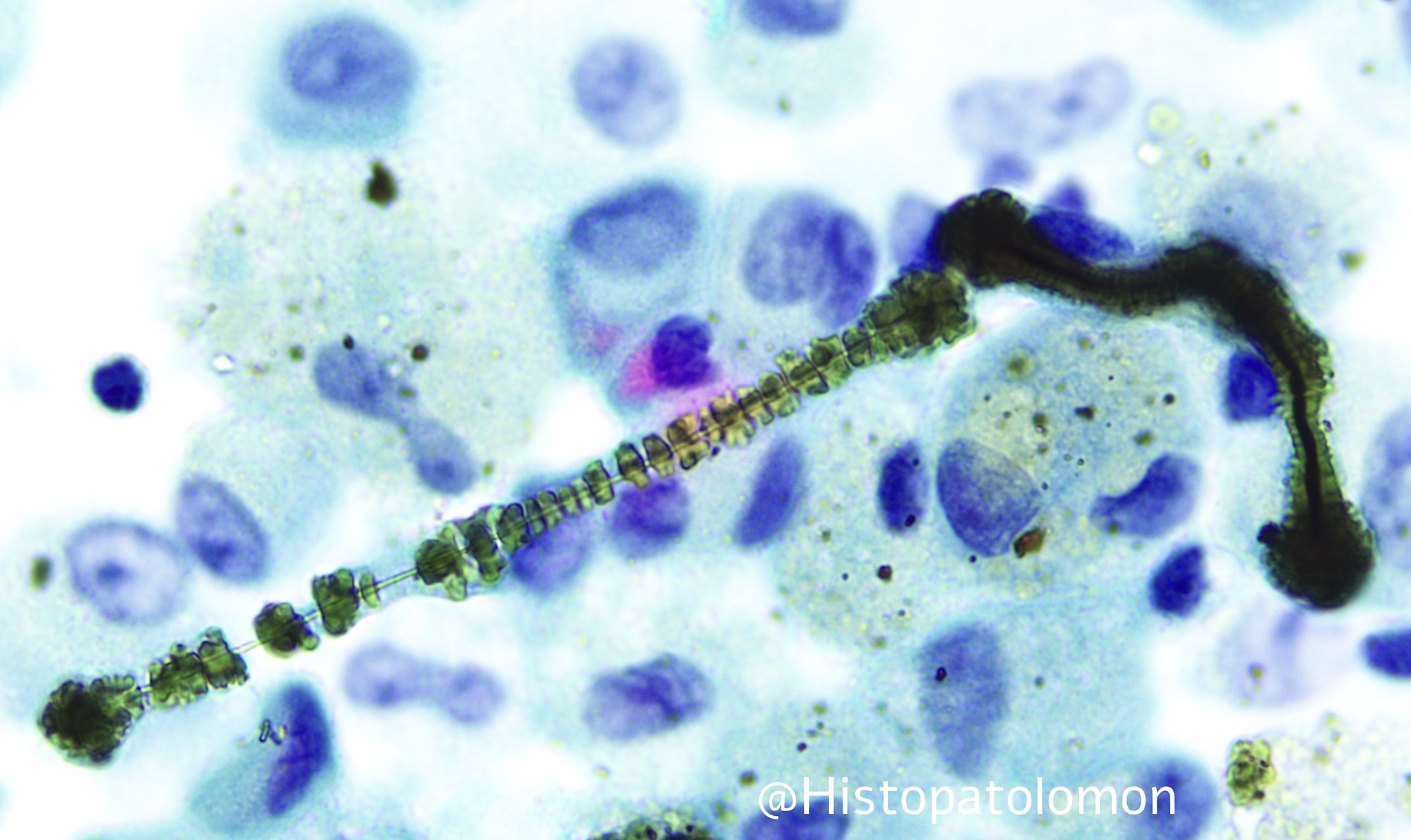 Asbestos and Non-Asbestos Ferruginous Bodies - BAL Cytology - Lung