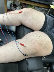 Acupuncture in my knees
