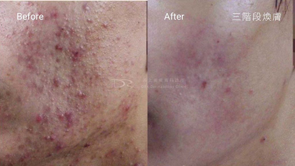 痘疤治療-粉刺-青春痘-青春期怎麼保養皮膚