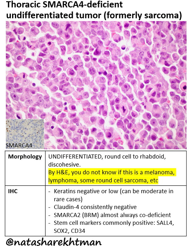 SMARCA4 deficient undifferentiated tumor