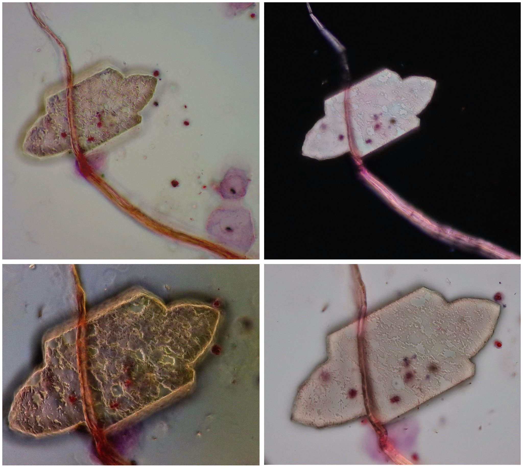 Uric acid crystal - Urinary cytology
