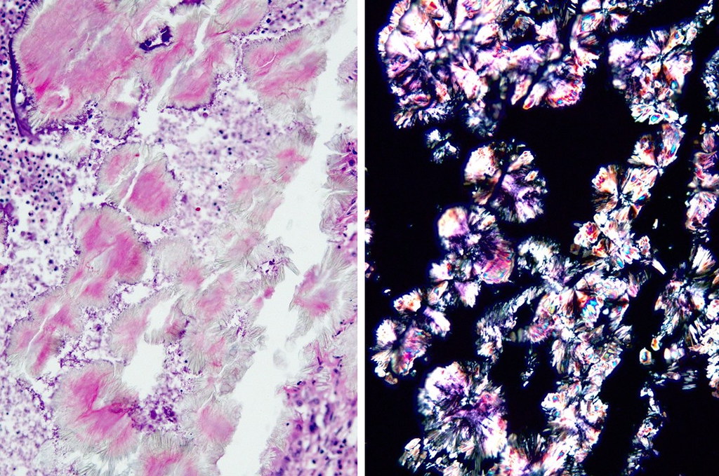 Calcium oxalate crystals - Lung