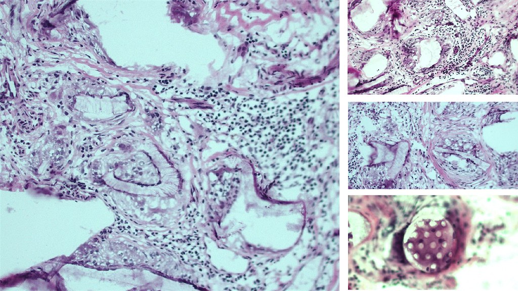 SurgiWrapFrost - Pelvic peritoneum