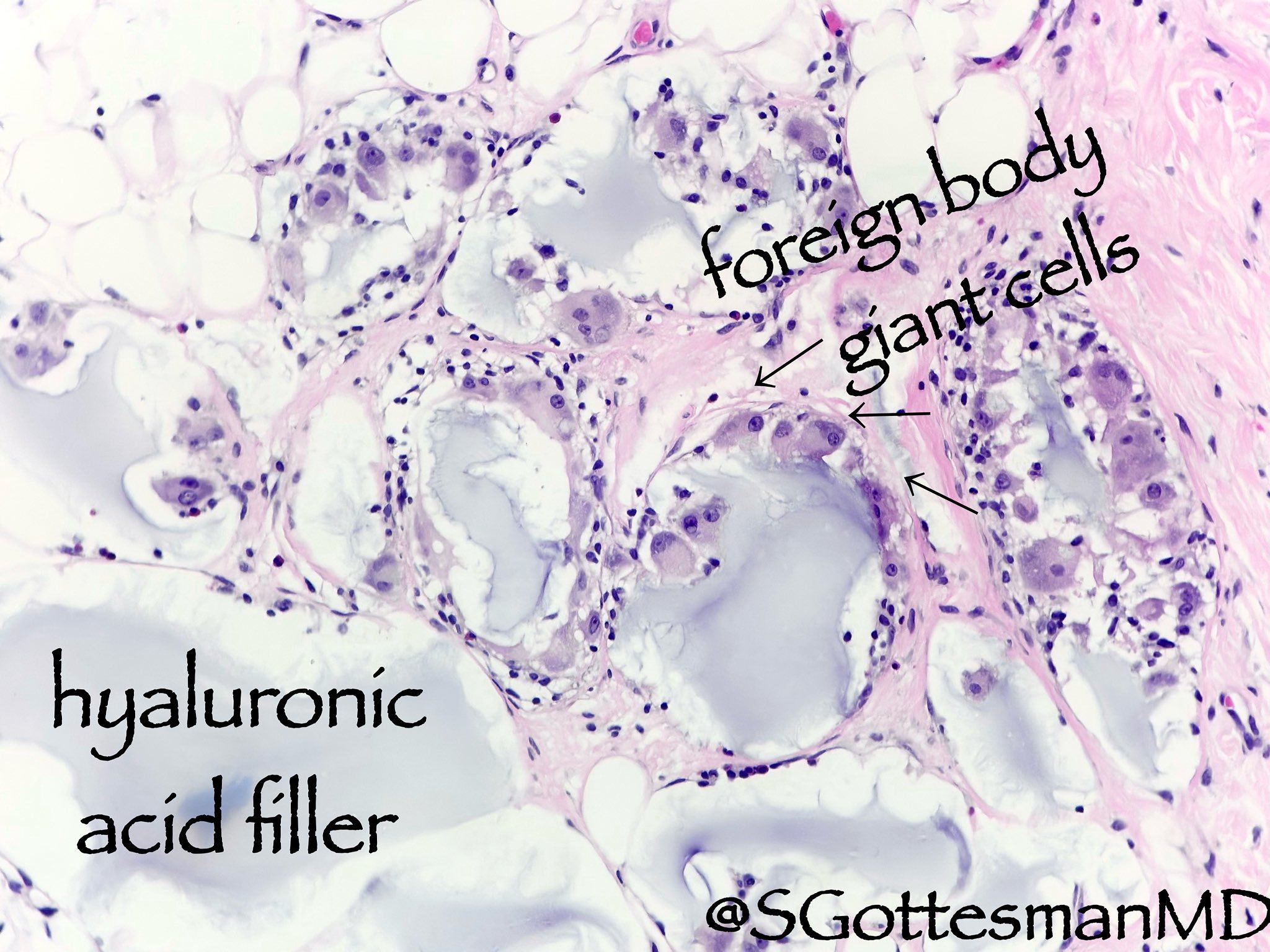 Hyaluronic acid - Mandibular skin
